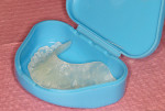 Figure 20  The finalized and polished splint is delivered to the patient in an orthodontic retainer case.