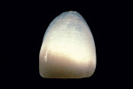 Figure 12  A powder and liquid veneer using highly translucent materials cervically and with an opacious dentin on the lingual of the incisal area.