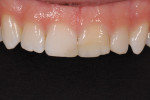 Figure 11 Preoperative view showing the patient’s discolored and chipped composite restorations on teeth Nos. 8 and 9, as well as unharmonious gingival heights and incisal edges.