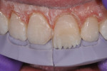 Figure 12 With the incisal matrix in place, the amount of length and fullness that could be added is apparent.