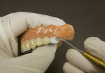 Figure 10 and Figure 11. Composite veneer placement is shown over denture teeth Nos. 12 and 13. Composite material retention is enhanced by prepared roughened FDM surfaces of the preparation, but can be removed largely intact and replaced if surfaces are lubricated.