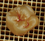 Figure 7. After firing, the restoration should exhibit depth of color on the occlusal surface.