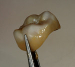 Figure 6. There is a thin, even wash on the gingival third of the restoration.