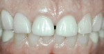 Figure 6  Preoperative gingival display.