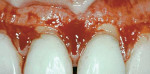 Figure 7  Full-thickness reflection. Note the coronal level of the alveolar crest.