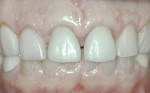 Figure 10  Gingival level after 4 weeks of healing. Minor apical pullback of tissue occurred postostectomy, but the level still approximates the initial presentation.