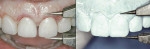Figure 11  Model of diagnostic wax-up (left) and clinical recapitulation of desired tooth dimensions using calipers (right).