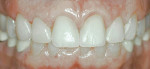 Figure 13  Final periodontal and restorative result after two-stage crown lengthening and porcelain veneer placement.