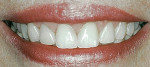 Figure 15  The patient’s smile after treatment.