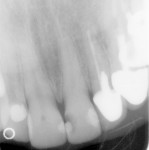 Figure 2  Preoperative radiograph of tooth No. 9.