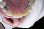 Figure 3  Preoperative lingual view of tooth No. 9.