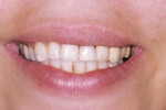Figure 16  Smile close-up postoperatively on tooth No. 9.