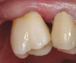 Figure 16  Postoperative view of the first impression-free zirconia-based restoration.