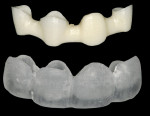 Figure 19  The milled zirconia framework and the plastic full-contour portion of the restoration.