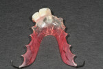 Figure 6 Transitional prosthesis and Kois deprogramming appliance that was used during the functional analysis and occlusal equilibration. This prosthesis was worn for approximately 3 weeks during the initial stage of healing for the extractions and socket preservation.