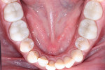 Figure 11 Post-treatment mandibular occlusal
view.