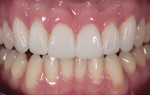 Figure 21 and Figure 22 Close-up views of the patient’s final BFEP restorations.