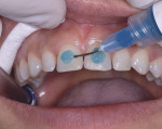 Figure 13 Following conservative tooth preparation, the facial surface of the teeth was etched, taking care to remain 0.5 mm away from the free gingival and interproximal margins.
