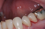 Figure 1 Routine dental procedures provide opportunities for pathogens on a clinician’s hands to be transferred into the patient’s bloodstream.