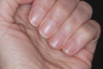 Figure 10 Fingernails should be filed smooth, short, and rounded to allow clinicians to clean thoroughly and prevent glove tears.
