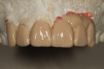 Figure 4 Diagnostic wax-up is completed on the model, including full restorative plan.