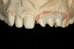 Figure 7 Milled zirconia implant substructure is fit onto model.