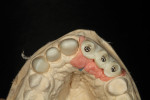 Figure 8 Occlusal view of arch assessed for single-unit restorations and implant structure alignment.