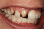 Figure 12 Right view shows lateral incisor and implant prosthesis seated in patient's mouth.