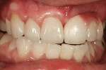 Figure 13 Try-in of restorations without hydration of  teeth.