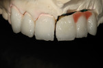 Figure 9 Dentin porcelain was applied to single zirconia units and base gingival porcelain shade added to implant prosthesis to try on the model.