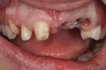 Figure 2 Gingival height and implant placement are compromised due to extent of trauma.