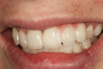 Figure 14 Left view shoes gingival porcelain blends naturally and papilla anatomy with the lip relaxed.