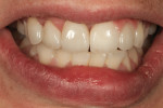 Figure 15 Frontal view with teeth hydrated shows smile line esthetics and harmony.