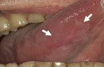 Figure 7 View of lateral tongue under white light with white lesion visible. Figure courtesy of the British Columbia Oral Cancer Prevention Program.