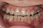 Figure 3 1:2 retracted smile with upper and lower teeth slightly apart. Patient desired a brighter, fuller smile.