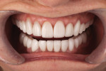 Figure 9 Teeth No, 10, No. 11, No. 12, and No. 13 were lengthened 1 mm with lithium disilicate veneers to make the smile appear more even, to the patient's satisfaction.