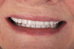 Figure 8 Teeth No, 10, No. 11, No. 12, and No. 13 were lengthened 1 mm with lithium disilicate veneers to make the smile appear more even, to the patient's satisfaction.