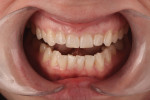 Figure 13 Using smile design techniques, tooth lengthening was proposed that would reduce the central width-to-height ratio to 76%.