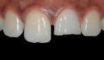 Figure 9  Retracted view of the fracture in tooth No. 9.