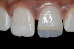 Figure 10  After bevel placement, etching, and bonding, a thin layer of an enamel-shaded composite (Artiste Enamel, Pentron Clinical Technologies) was placed with the aid of a silicon index to reproduce the palatal enamel.