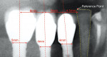 Figure 5 Nearby natural tooth serves as reference point to determine initial mesial-distal position for screw access.
