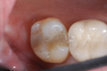 Figure 2 Tooth No. 2 prior to the preparation, with recurrent decay on the distal extending onto the pulpal floor.