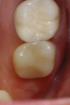 Figure 5 Tooth No. 2 after the final restoration.
