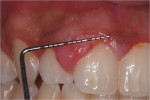 Figure 3 and Figure 4  A sessile gingival enlargement measuring approximately 12 mm x 9 mm. The lesion was red in color and clearly demarcated from its surrounding tissues.
