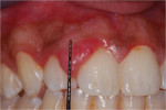 Figure 3 and Figure 4  A sessile gingival enlargement measuring approximately 12 mm x 9 mm. The lesion was red in color and clearly demarcated from its surrounding tissues.