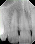 Figure 5  Radiographic appearance of area between teeth Nos. 7 and 8. No osseous involvement could be seen.