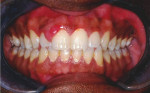 Figure 1 Preoperative view of a 26-year-old male patient with an isolated gingival enlargement between teeth Nos. 7 and 8.