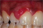 Figure 2  A closer view of the gingival enlargement between teeth Nos. 7 and 8.