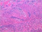 Figure 12  Characteristic strands and nests of odontogenic epithelium interspersed throughout the connective tissue.
