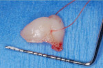 Figure 7 through Figure 9 Biopsy procedure depicted: A 4.0 gut suture was used to secure the specimen while it was excised at the base.